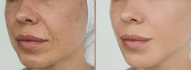 Kadın tedaviden önce ve sonra kırışıklıklarla karşılaşır