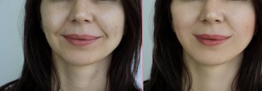 Kadın tedaviden önce ve sonra kırışıklıklarla karşılaşır