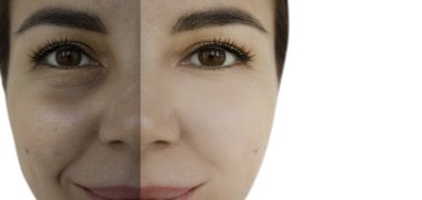 Kadın tedaviden önce ve sonra kırışıklıklarla karşılaşır