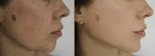 Морщины Лица Женщины После Лечения — стоковое фото