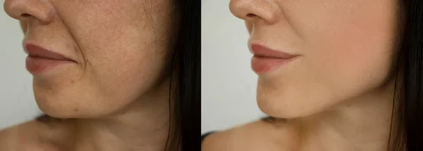 Rugas Cara Mulher Antes Após Tratamento — Fotografia de Stock