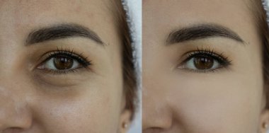  Kadın tedaviden önce ve sonra kırışıklıklarla karşılaşır