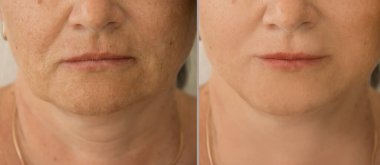  Kadın tedaviden önce ve sonra kırışıklıklarla karşılaşır