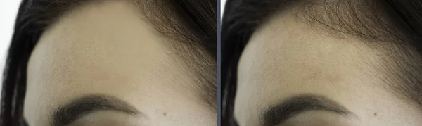 Łysienie Głowy Kobiety Przed Leczeniu — Zdjęcie stockowe
