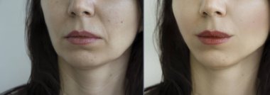 Kadın tedaviden önce ve sonra kırışıklıklarla karşılaşır