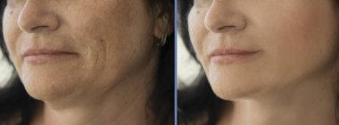 Kadın tedaviden önce ve sonra kırışıklıklarla karşılaşır