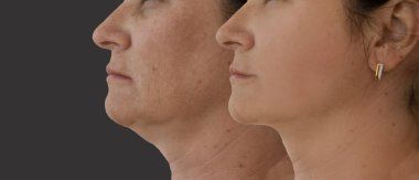 Kadın tedaviden önce ve sonra kırışıklıklarla karşılaşır