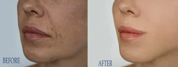 woman face wrinkles before and after treatment