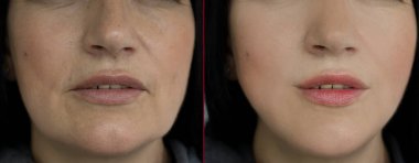 Kadın tedaviden önce ve sonra kırışıklıklarla karşılaşır