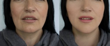 Kadın tedaviden önce ve sonra kırışıklıklarla karşılaşır