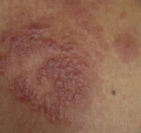 Malattia Dell Eczema Sulla Pelle Vicino — Foto Stock