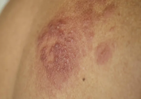 Eczema disease on the skin close up