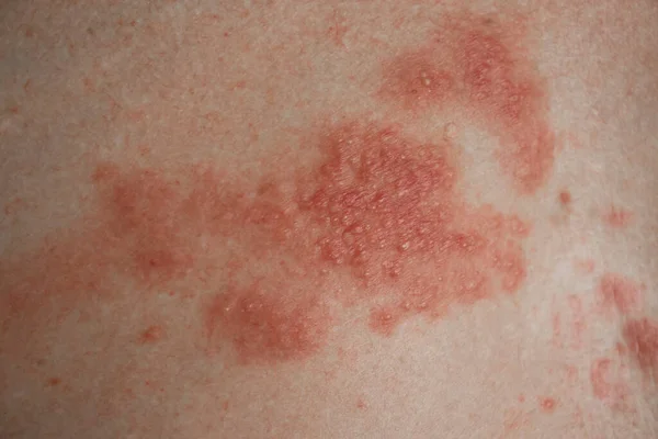 Eczema Doença Pele Perto — Fotografia de Stock