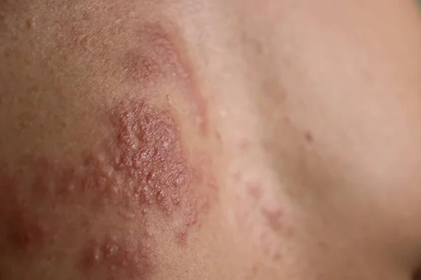 Έκζεμα Ασθένεια Στο Δέρμα Από Κοντά — Φωτογραφία Αρχείου