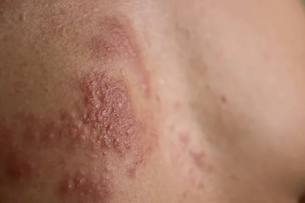 Eczema disease on the skin close up