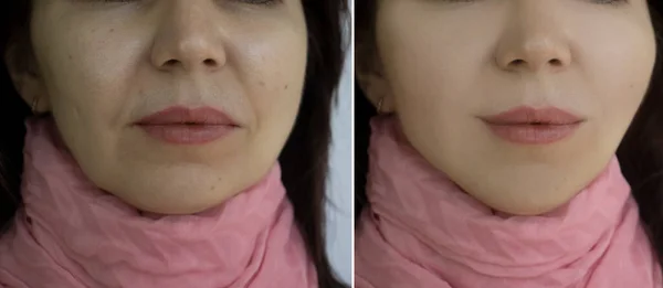 Wanita Wajah Keriput Sebelum Dan Setelah Pengobatan Dagu Ganda — Stok Foto