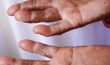 Beyaz arka planda vitiligo derisi pigmentasyonu olan yaşlı bir Hintli kadın elleri. Yaşam tarzı deri hastalıkları kavramları.