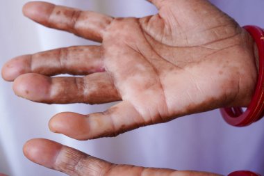 Beyaz arka planda vitiligo derisi pigmentasyonu olan yaşlı bir Hintli kadın elleri. Yaşam tarzı deri hastalıkları kavramları.