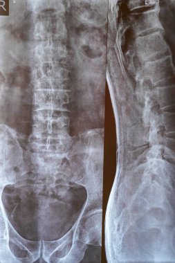 Röntgen görüntüleme tekniği, kapsamlı tıbbi analizler için bel omurgası ve leğen kemiği bölgesini göstermek için kullanılır.