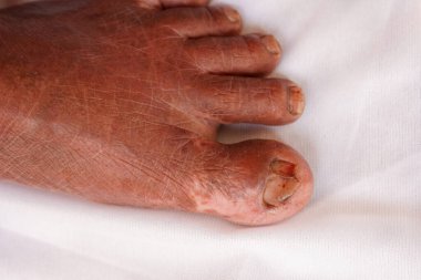 Beyaz arka planda vitiligo ya da lökoderma derisi pigmentasyonu olan yaşlı bir Hintli kadın ayağı. Yaşam tarzı deri hastalıkları kavramları.