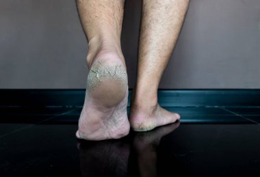 Kırık topuğu kapat. Derin çatlaklar ve kuru cilt.