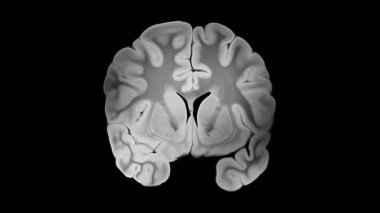 Alzheimer beyin ilerlemesi, koronal arkaplanda kortikal atrofi, genişletilmiş sulci ve genişlemiş ventriküller ile bir yarımküreyi gösterirken karşı tarafın sağlıklı kaldığını gösteriyor..