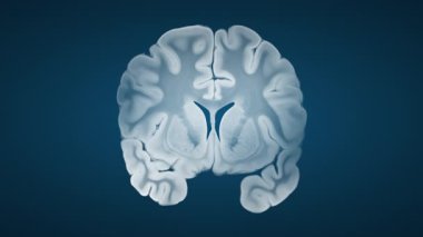 Mavi arka plandaki koronal görüntüde Alzheimer beyin gelişimi kortikal körelme, genişletilmiş sülfür ve genişlemiş ventriküller gibi sağlıklı hastalıklardan gelişmiş hastalıklara geçişi gösteriyor..