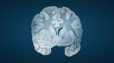 Alzheimer beyin karşılaştırması mavi arkaplanda kortikal atrofi ve ventriküler genişleme ile birlikte bir yarımkürenin sağlıklı kaldığını gösteriyor..