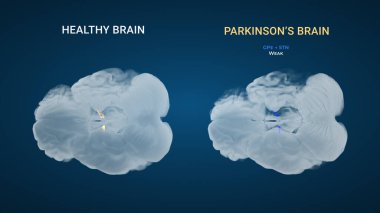 Parkinson GPN zayıf dolaylı yol karşılaştırması gösteriyor ki mavi arka plandaki sağlıklı beyne karşı subtalamik çekirdek inhibitör projeksiyonu