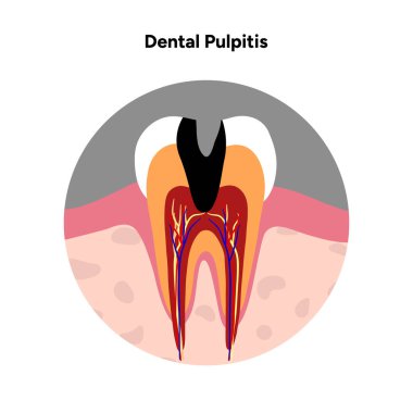 Diş anatomisinde diş pulpiti olduğunu gösteren elle çizilmiş diş bilgisi. Enamel, dentin, lapa odası, sinir iltihabı ve etkilenen kanal bölgeleri.