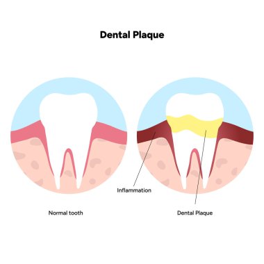 Diş anatomisinde diş plağının oluşumunu gösteren elle çizilmiş diş bilgisi. Diş minesi, diş macunu, sakız çizgisi ve bakteriyel birikim alanı içerir