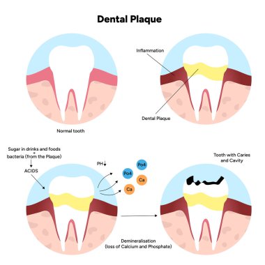 Diş anatomisinde diş plağının oluşumunu gösteren elle çizilmiş diş bilgisi. Diş minesi, diş macunu, sakız çizgisi ve bakteriyel birikim alanı içerir