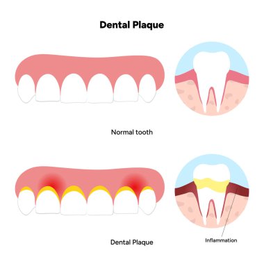 Diş anatomisinde diş plağının oluşumunu gösteren elle çizilmiş diş bilgisi. Diş minesi, diş macunu, sakız çizgisi ve bakteriyel birikim alanı içerir