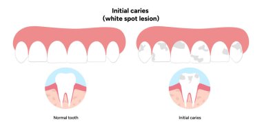 Elle çizilmiş diş bilgisi ilk başta beyaz leke olduğunu gösteriyor. Diş mineralizasyonu, diş katmanları, diş minesi yüzey değişiklikleri ve erken aşama bozulmalarını gösterir.