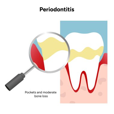 Diş eti, kökler ve destekleyici yapılar da dahil olmak üzere periodontal problemleri olan diş anatomisini elle çizilmiş diş bilgisi. Diş eğitimi ve mesleki dişçilik içeriği