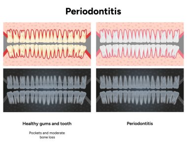 Hand-drawn dental illustration featuring expanded upper and lower rows of teeth with periodontal problems, healthy teeth. Computer tomography (CT) scans that highlight bone loss, gum recession 
