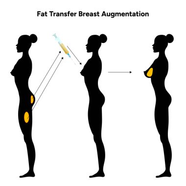 Kadınların göğüs yağı transferi takviyesi. Tıbbi kadın diyagramı