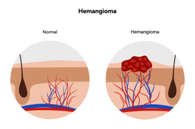 İnsan hemanjiyomu derisi mikrobiyolojisi. Yakınlaştırmada tıbbi görüntüleme