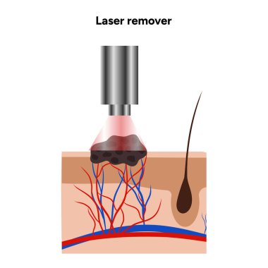 Farklı türde deri lezyonlarının lazer çıkarıcısı papillon, doğum lekesi, ben, melanom, keratom, hemanjiyom.