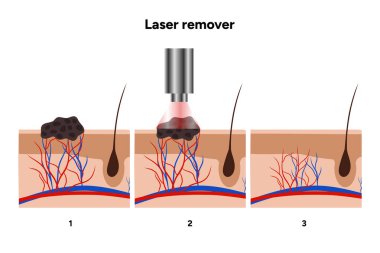 Farklı türde deri lezyonlarının lazer çıkarıcısı papillon, doğum lekesi, ben, melanom, keratom, hemanjiyom.