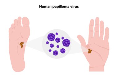İnsan papilloma virüsü insan ayağına yakından bakıyor. İnsanlarda HPV