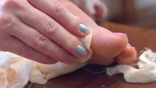 女性は手術後に医療用抗菌液で湿らせた綿パッドを使用して皮膚を治療し、足の傷を癒すステッチ.彼女は包帯を作る方法をジェスチャーで示しています,閉じる — ストック動画