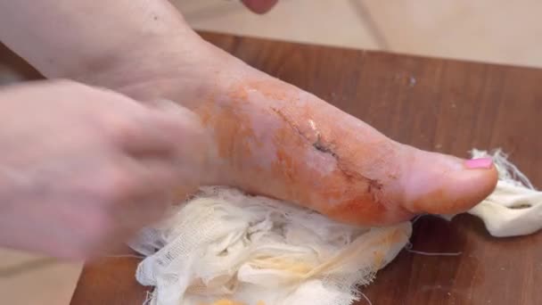 Seseorang merawat kulit dan jahitan saat menyembuhkan luka kaki menggunakan pad kapas yang dibasahi dengan larutan antibakteri medis setelah operasi. Persiapan untuk perban — Stok Video