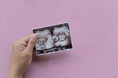 Ultrason fotoğrafında hamile bir kadın kalp şeklinde ellerini uzattı. Hamilelik ve annelik kavramı.