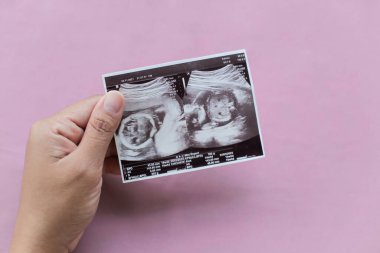 Ultrason fotoğrafında hamile bir kadın kalp şeklinde ellerini uzattı. Hamilelik ve annelik kavramı.