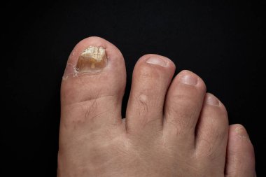 Bir insanın ayağında mantar enfeksiyonundan dolayı sarı bir ayak tırnağı ve kahverengi bir uç vardır..