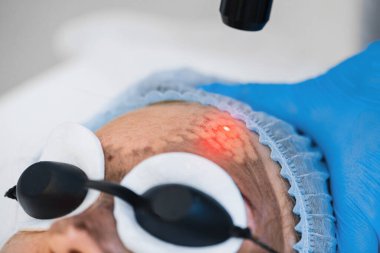 Yüz derisinin lazer karbon fiber kaplaması. Lazer cilt yenilenmesi.