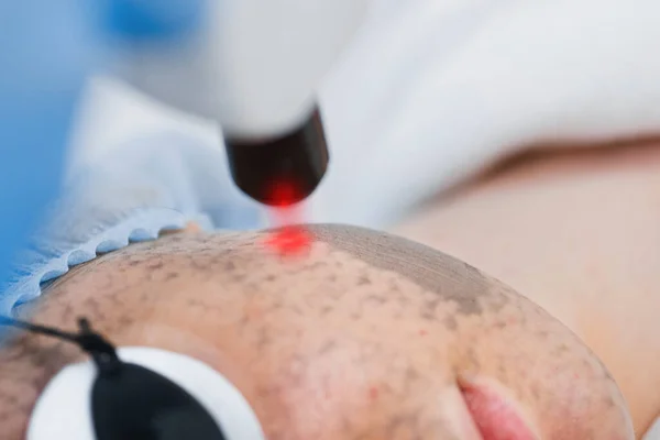 Yüz derisi lazer soyma prosedürü. Cilt yenileme makinesi lazer ışını.