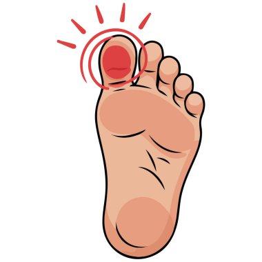 Şişmiş ayak parmağı yaralanması. Beyaz arka planda izole vektör çizimi.