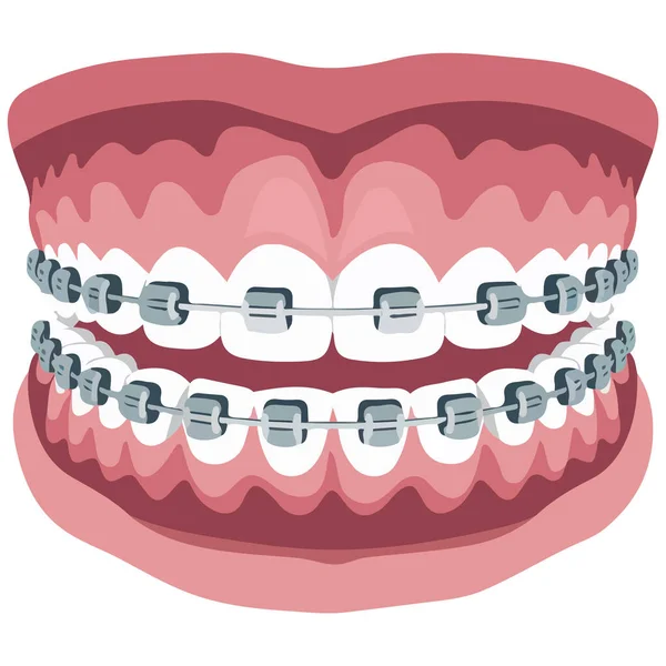 Gülümse diş hizalama beyazlatma işlemi beyaz arkaplanda izole vektör çizimi